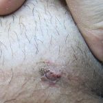 آزمایش HPV زگیل تناسلی